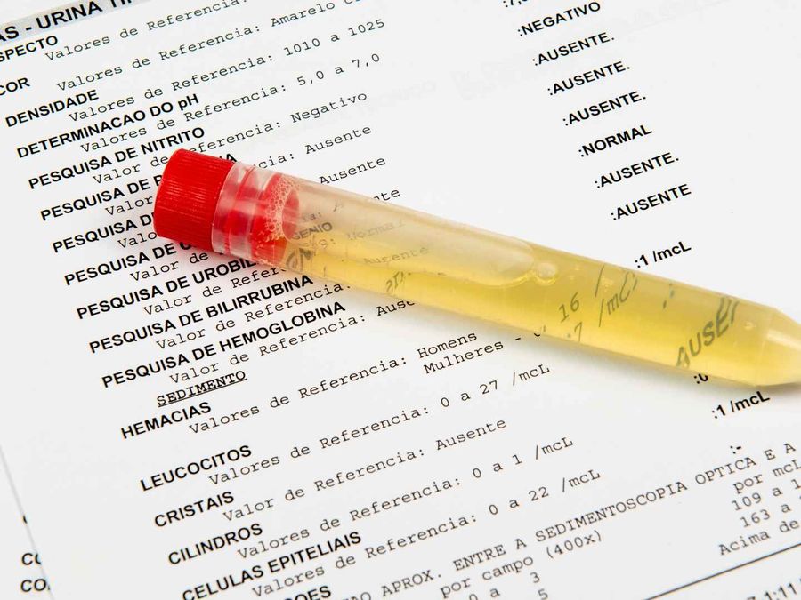 Uric acid and purine metabolism testing