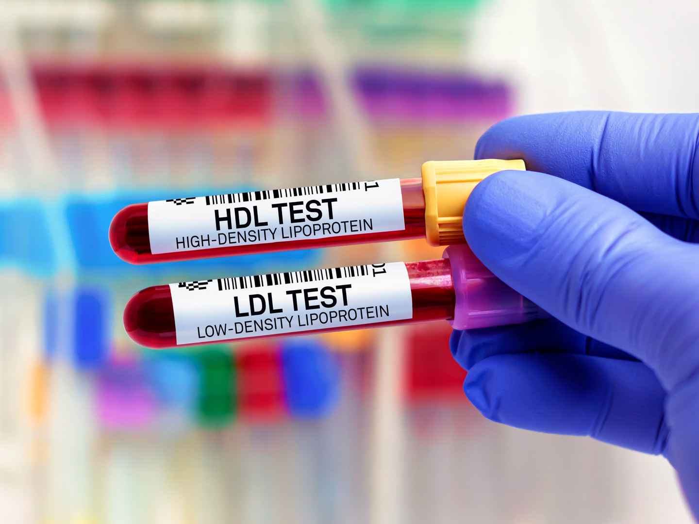 Blood samples of patient for High Density Lipoprotein HDL and Low Density Lipoprotein LDL test in laboratory