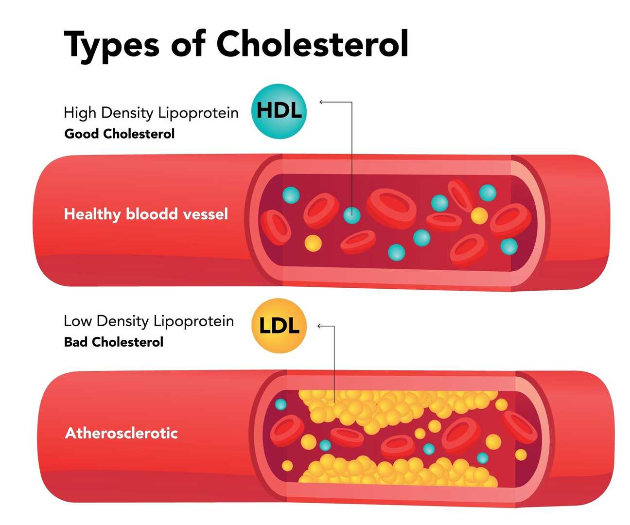 Types of cholesterol comparison with HDL and LDL