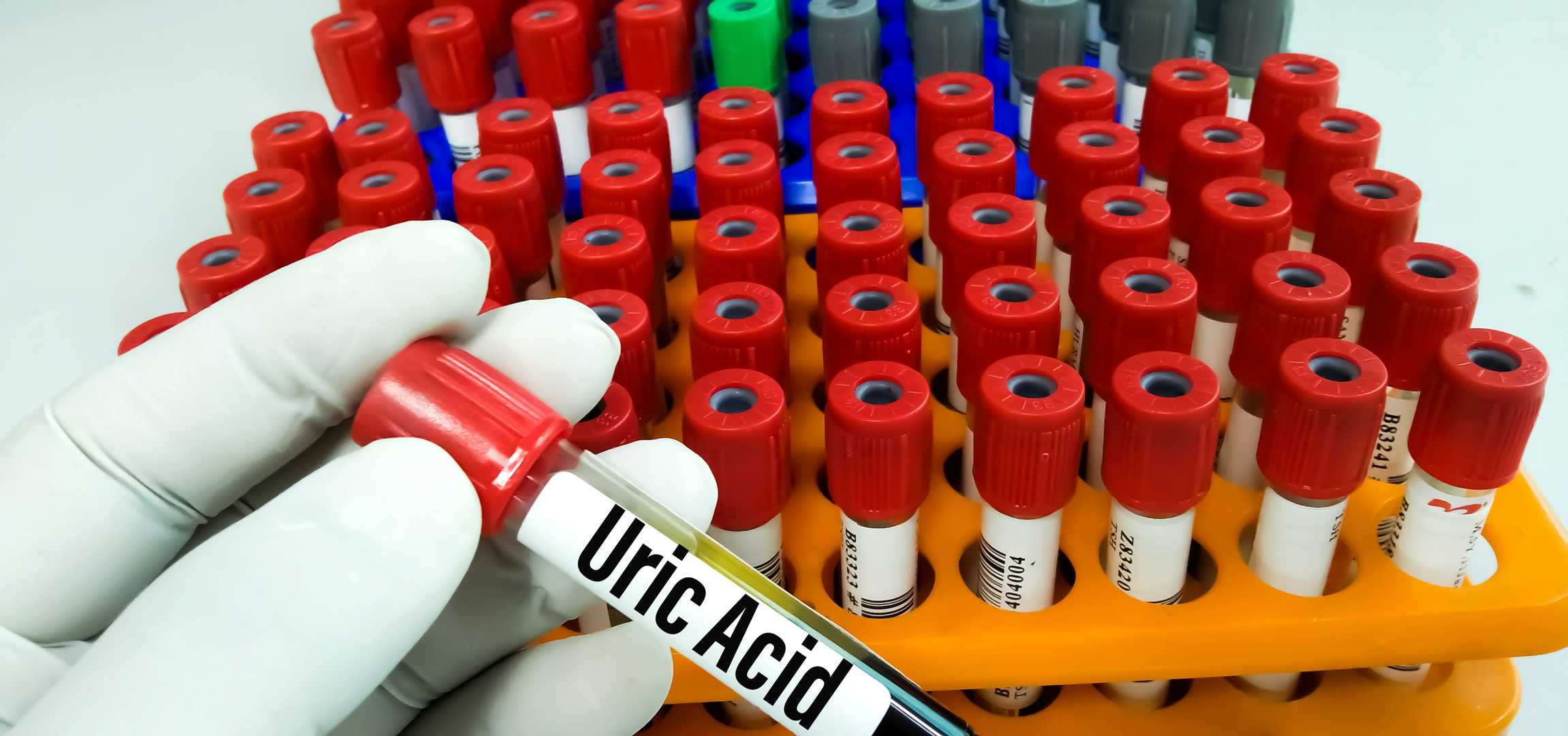 Uric acid assay enzymes, reaction components, and diagnostic kits